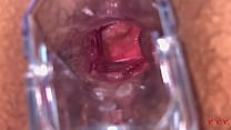 Anal Vision Speculum Anal Vision Speculum